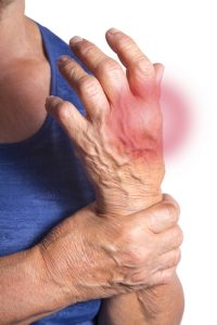 Artrite Reumatoide, tutto quello che c'è da sapere